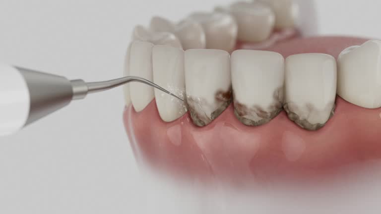 Trusted Wisdom Tooth Removal service in Nipomo, CA - Dentist Open Now